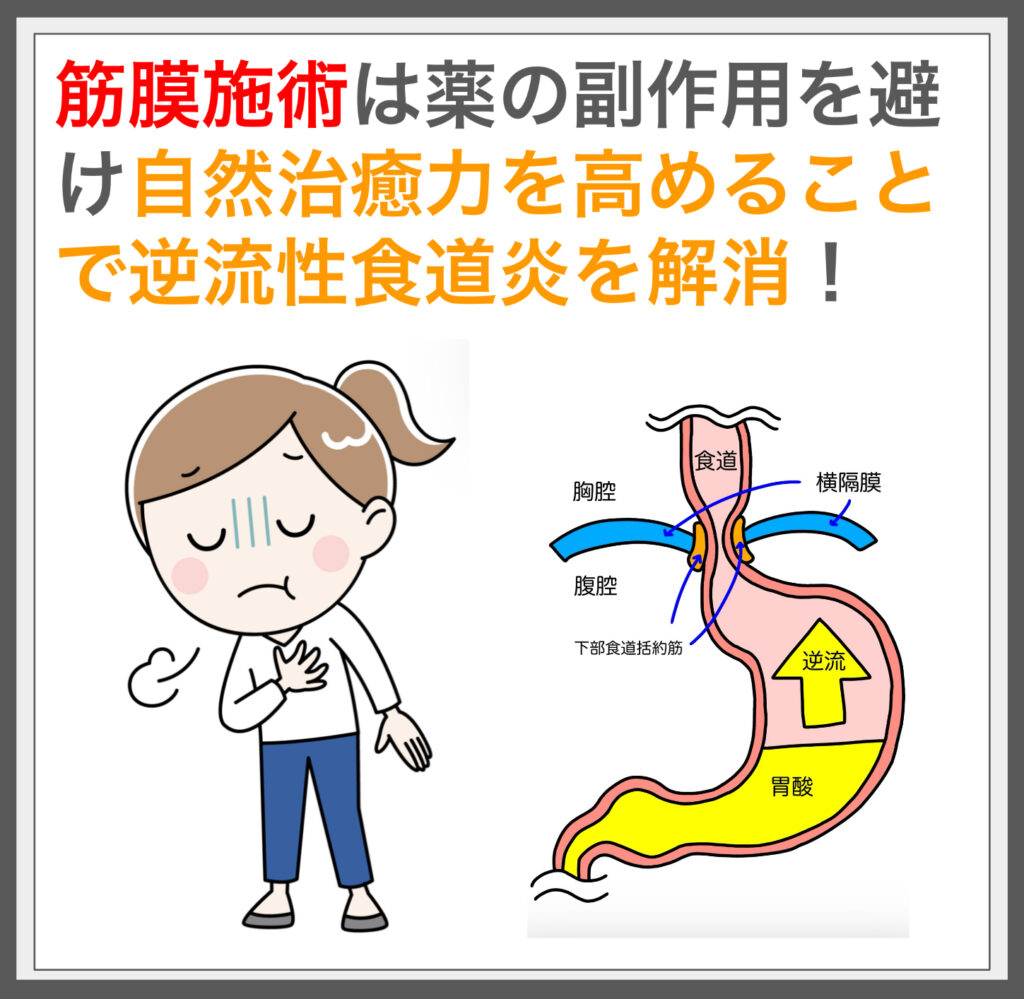 筋膜施術で胃酸逆流を改善し痛みと不快感から解放！