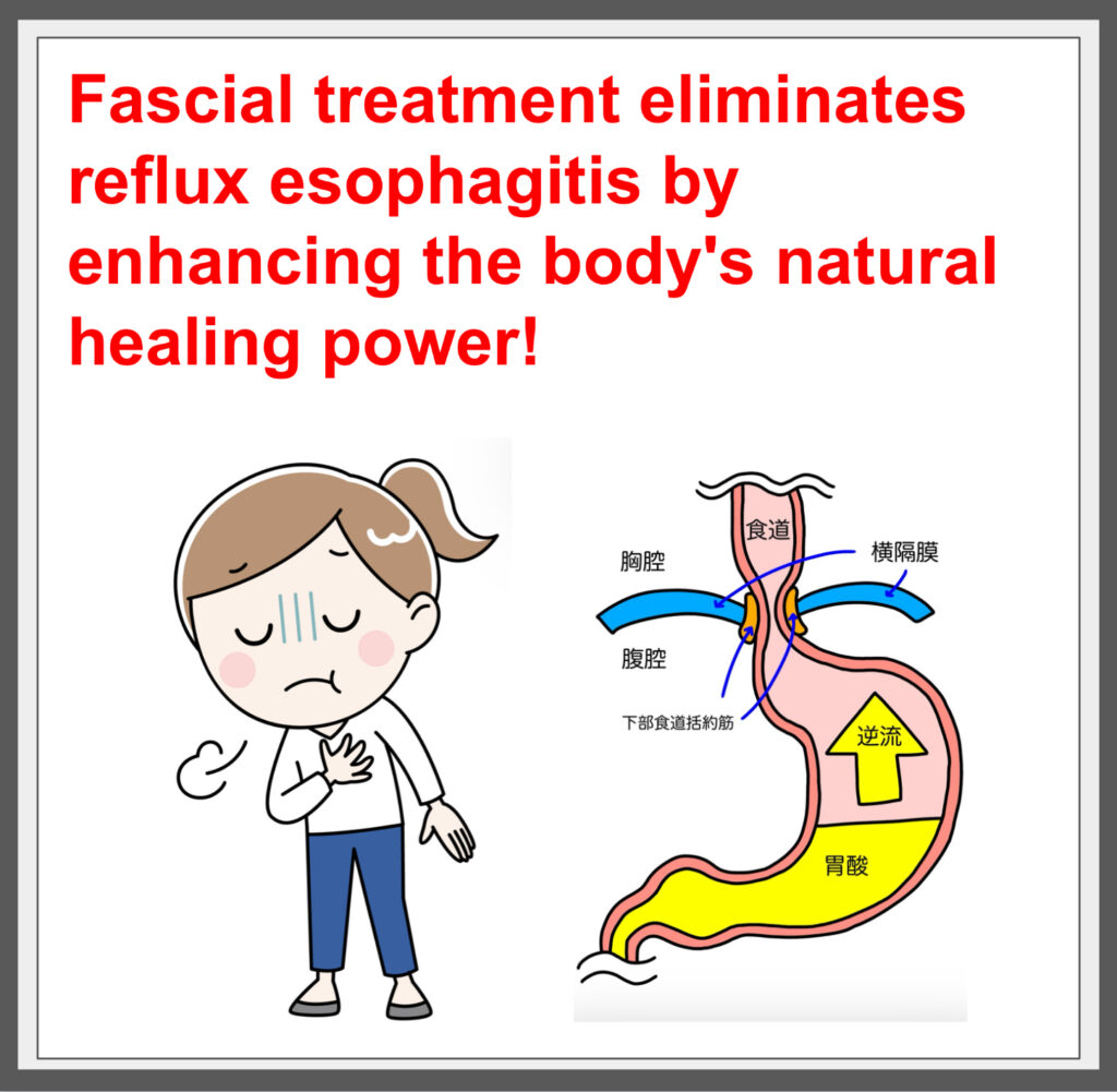 Improved gastric acid reflux with fascial treatment. ^^