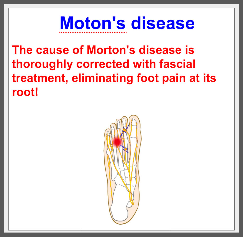 End Morton's disease with fascial treatment!^^