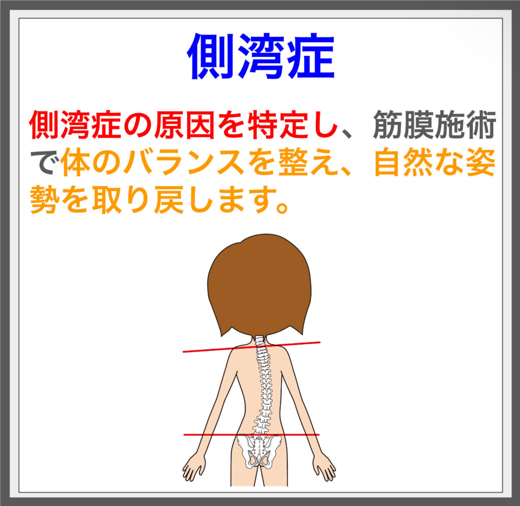 側湾症の要因を解消、筋膜施術で姿勢を整える