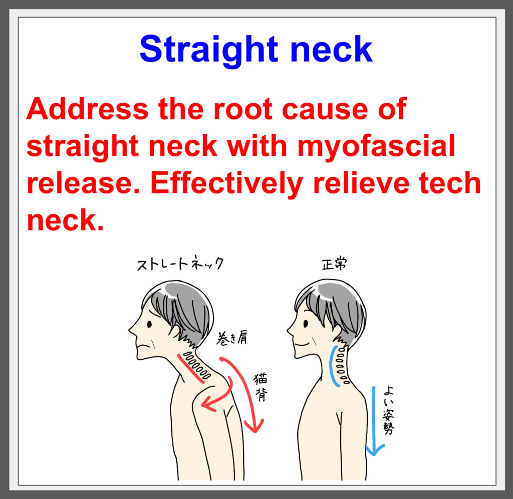 Effective for Tech Neck! Get Relief with fascial treatment!^^