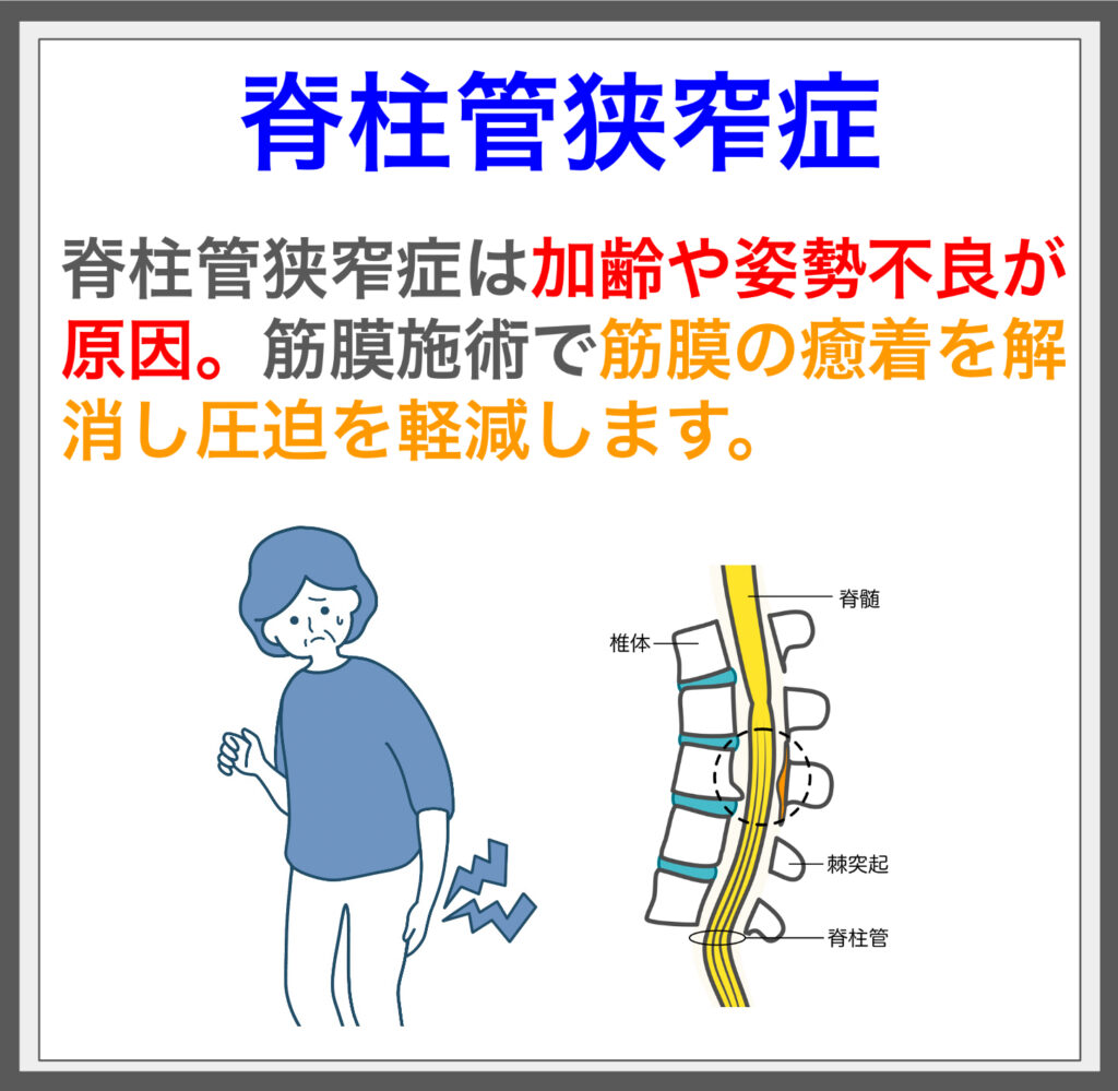 脊柱管狭窄症の原因を探り、筋膜施術で根本から解消！