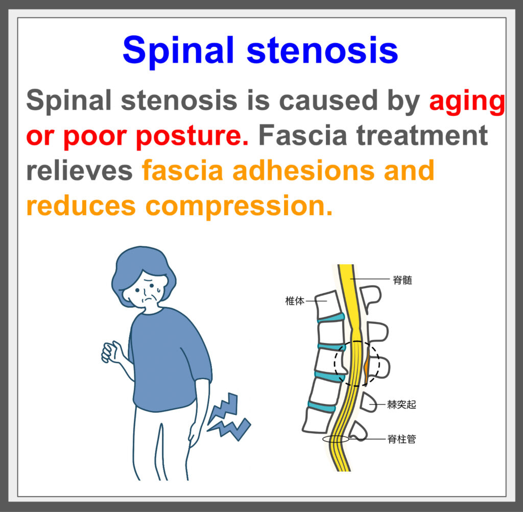 Identifying spinal stenosis causes, curing with fascia treatment!