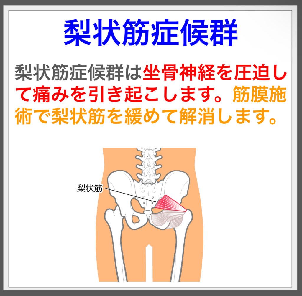 梨状筋症候群は神経圧迫で痛み。筋膜施術で解消。