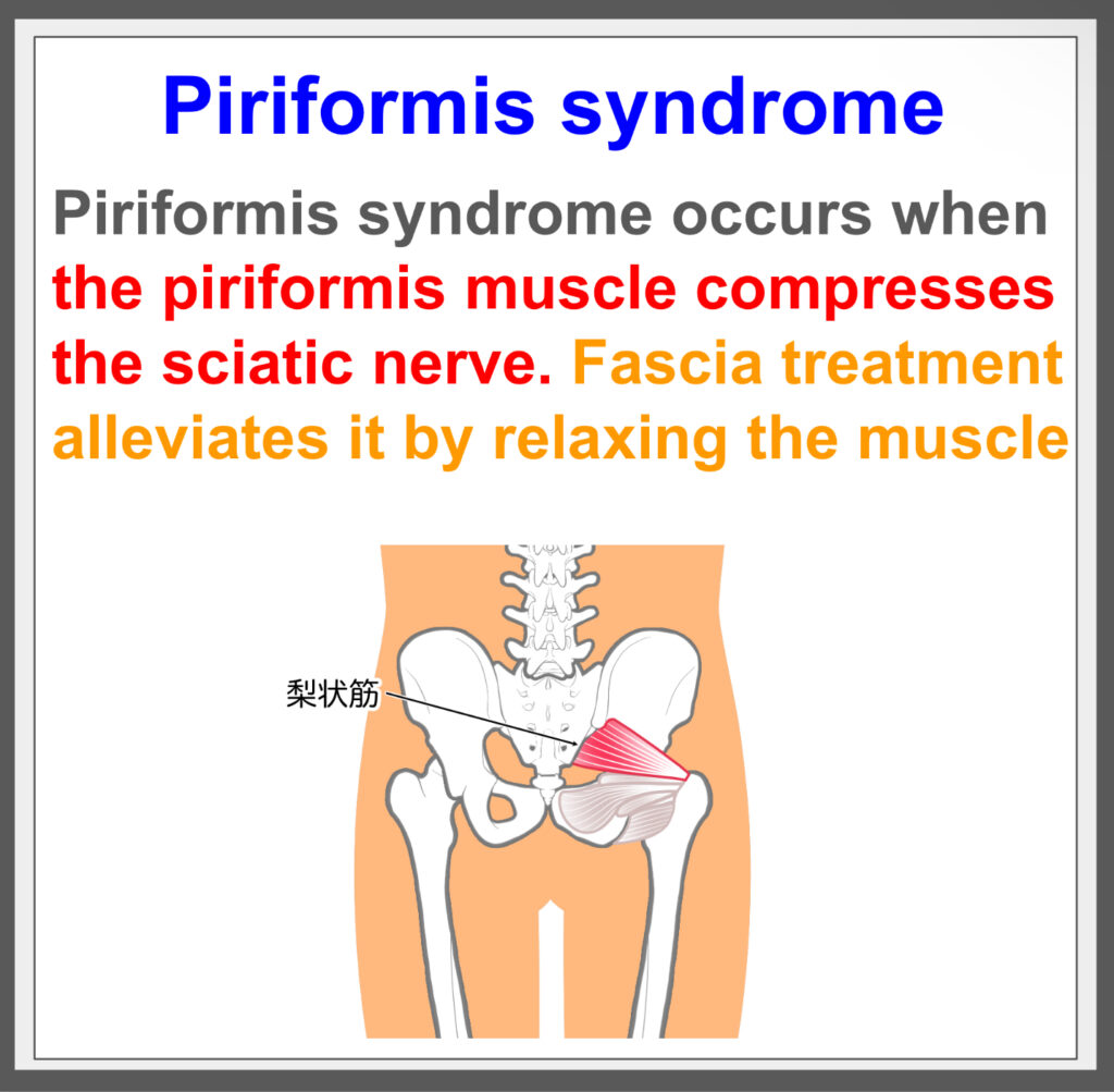 Piriformis syndrome causes nerve pain. Fascia treatment helps.