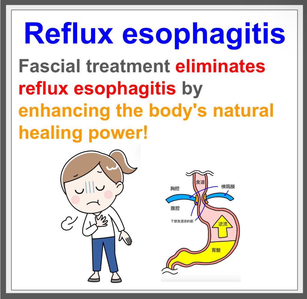 Fascial treatment improved acid reflux,.