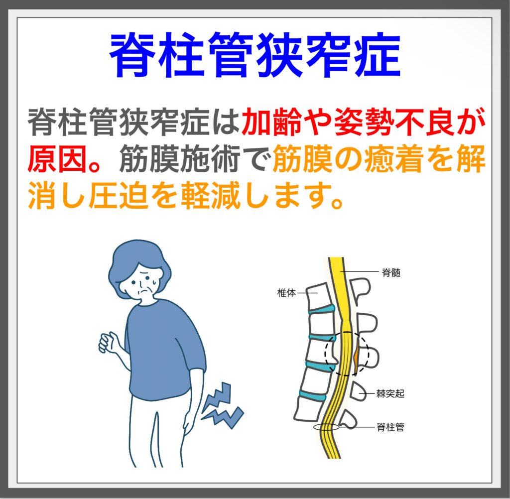 脊柱管狭窄症の原因を探り、筋膜施術で根本から解消！