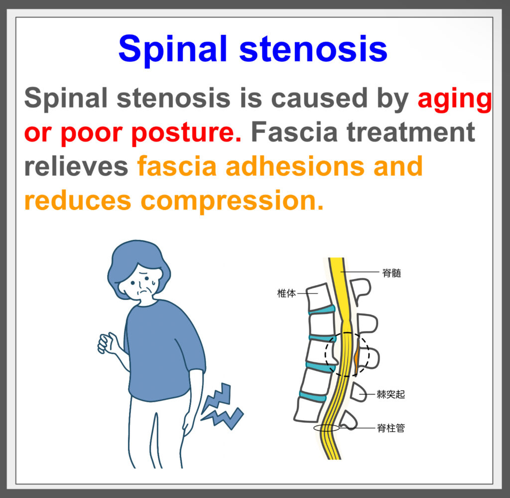 Identifying spinal stenosis causes, curing with fascia treatment!