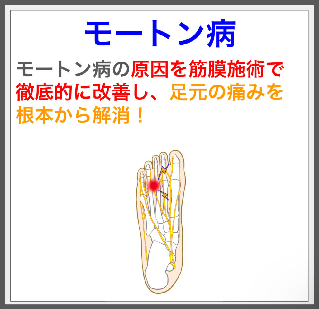 足裏の痛みを解消！筋膜施術でモートン病に終止符！