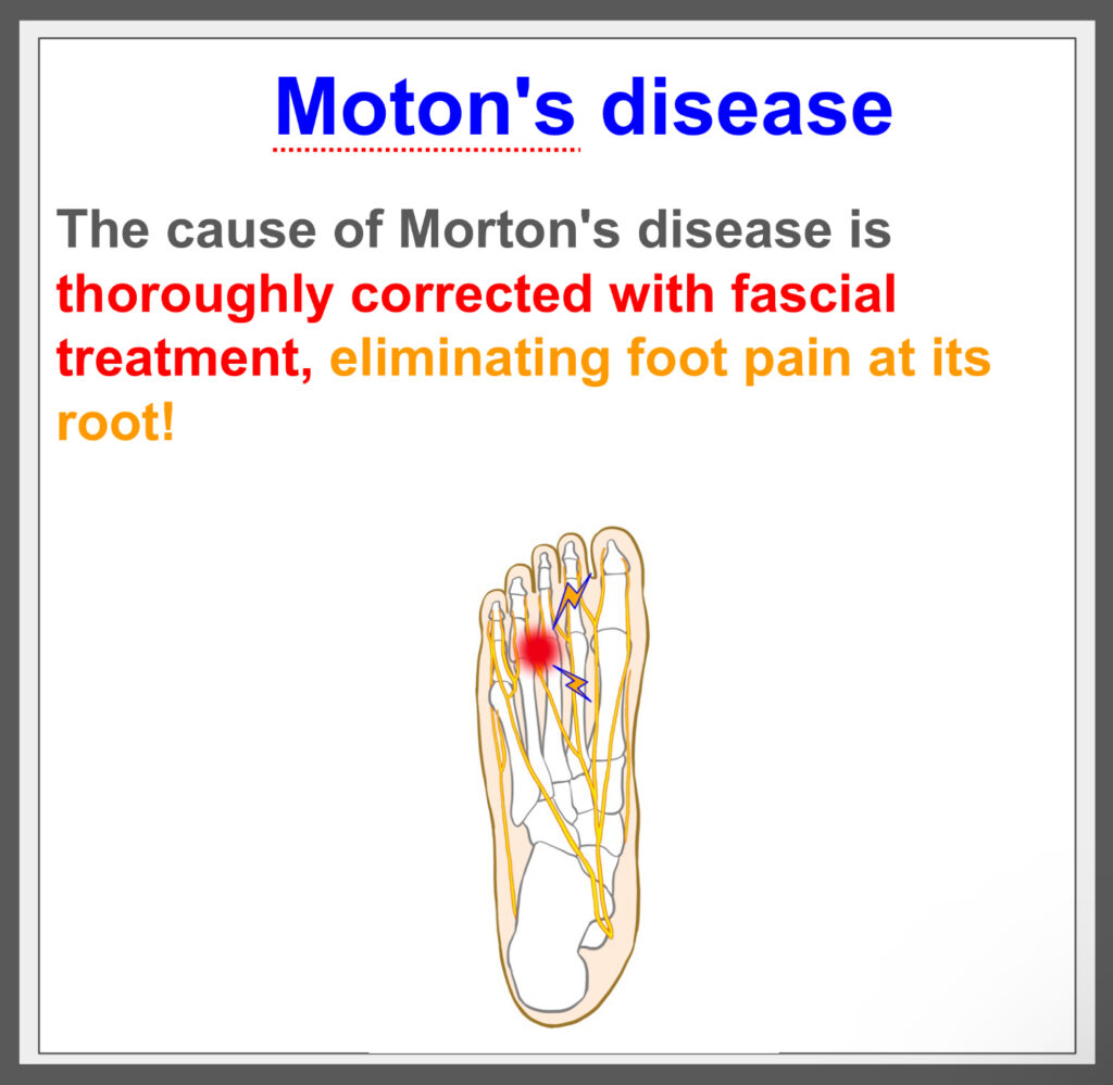 End Morton's disease with fascial treatment!