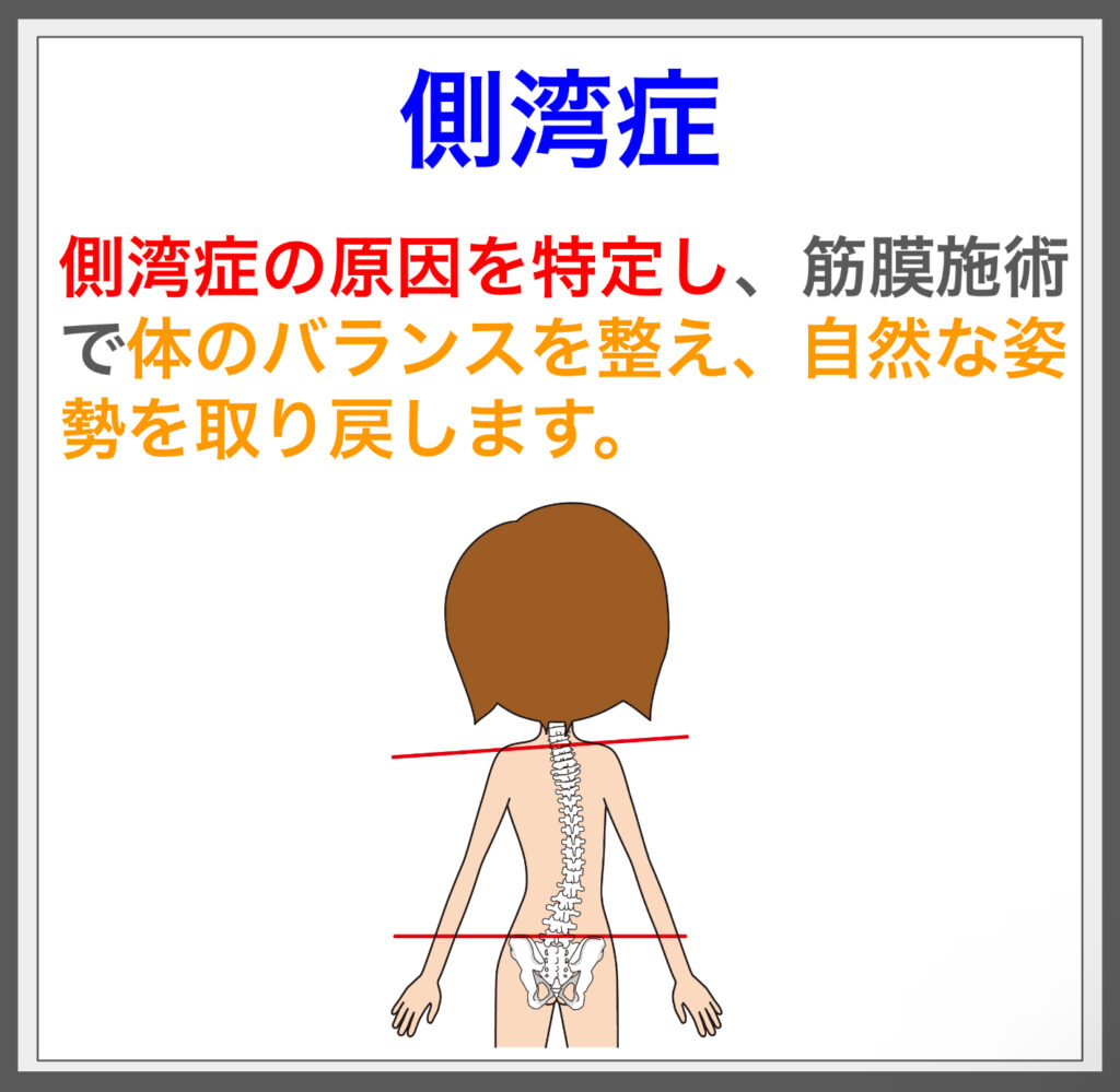 側湾症の要因を解消、筋膜施術で姿勢を整える！