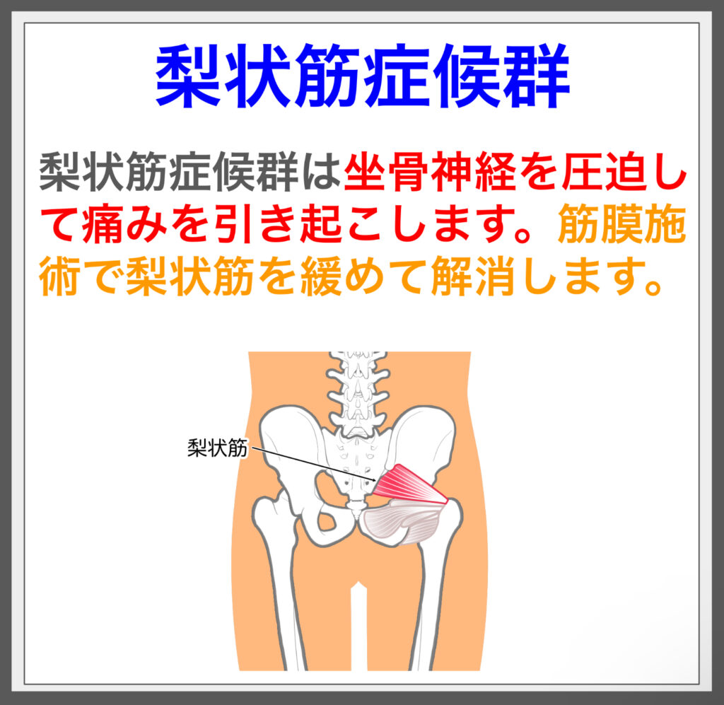 梨状筋症候群は神経圧迫で痛み。筋膜施術で解消。