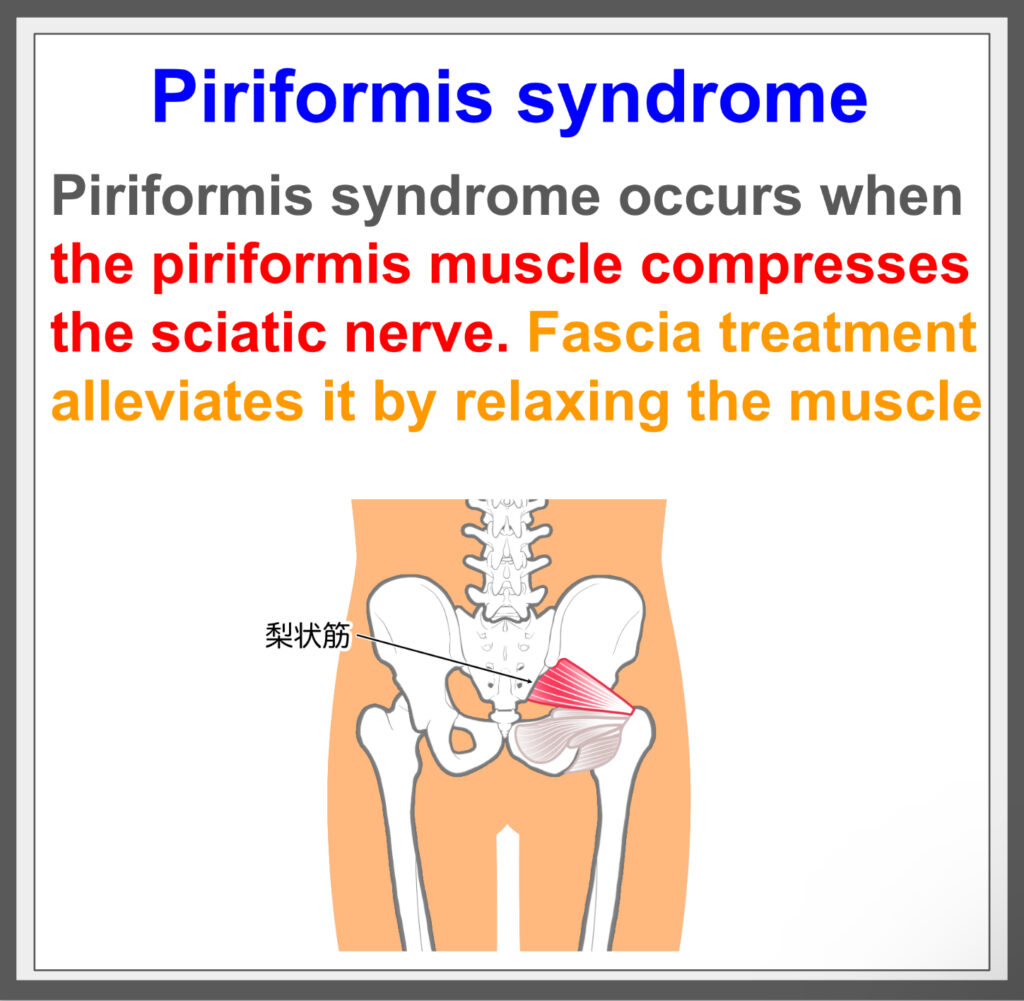 Piriformis syndrome causes pain; fascia helps.