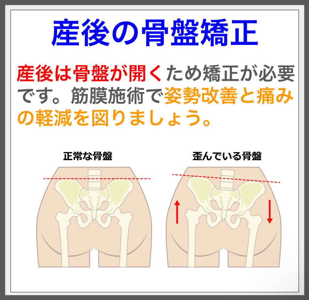 骨盤の歪み解消！筋膜施術で姿勢改善、痛みスッキリ。